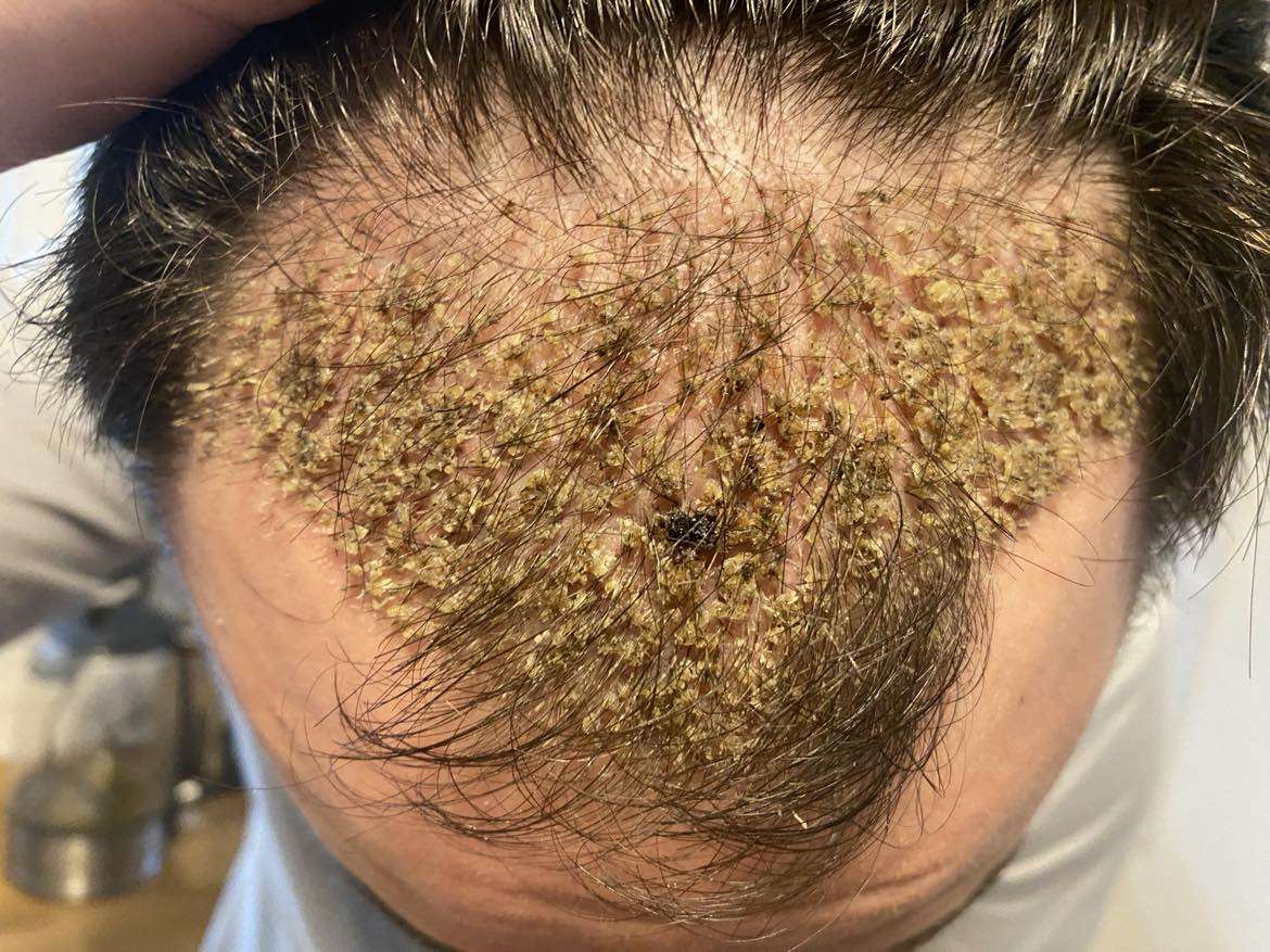 Causes of hair loss