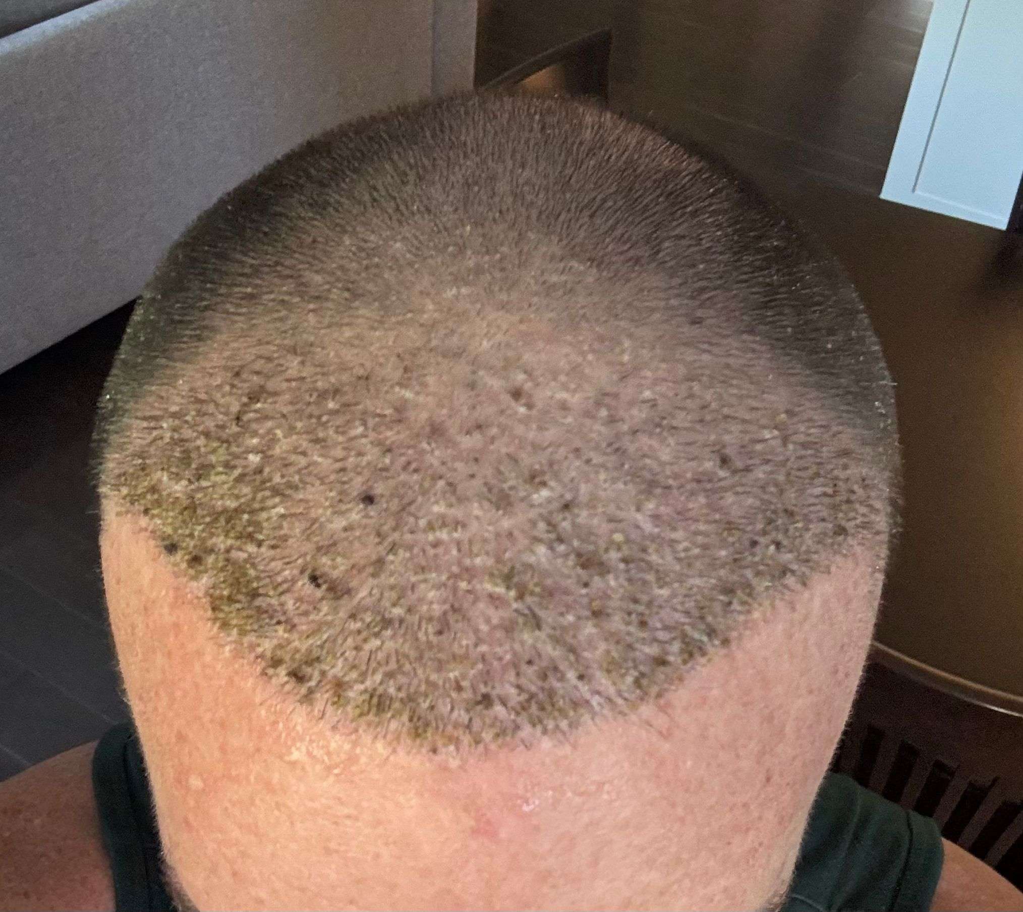 Hair Transplant